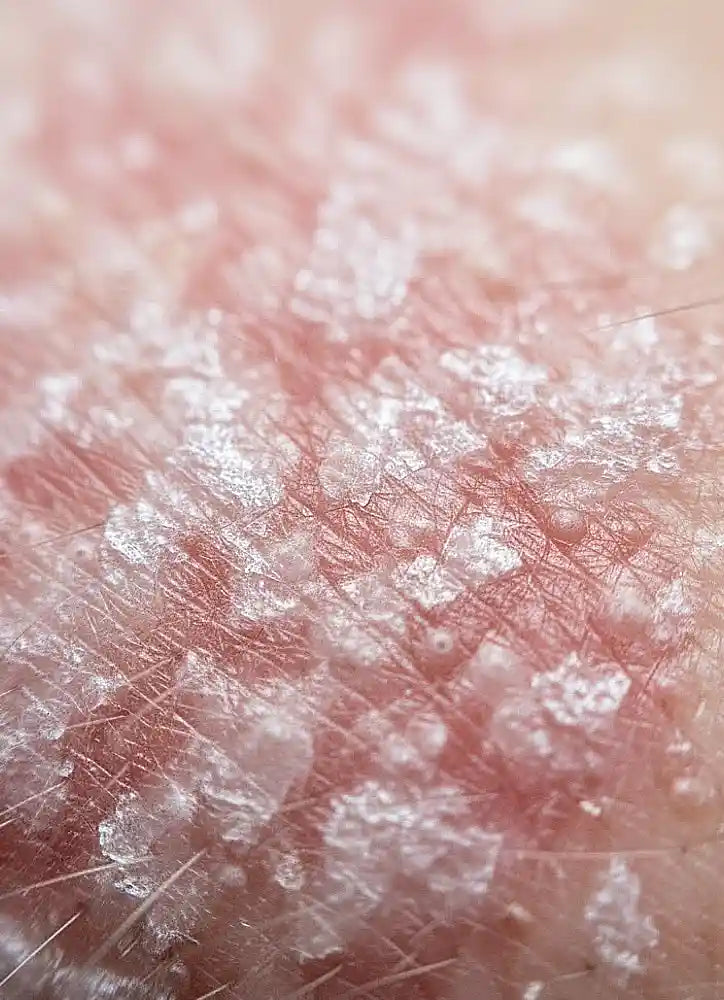 Close-up of skin with a white, flaky