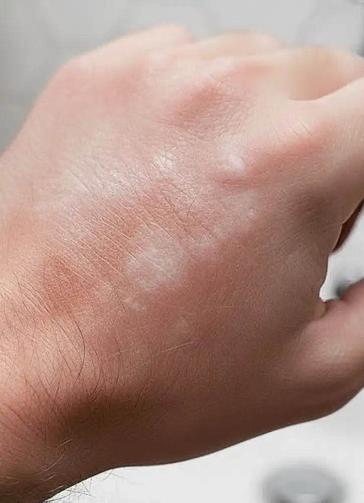 Close-up of a person's hand with visible skin texture and slight blemishes.