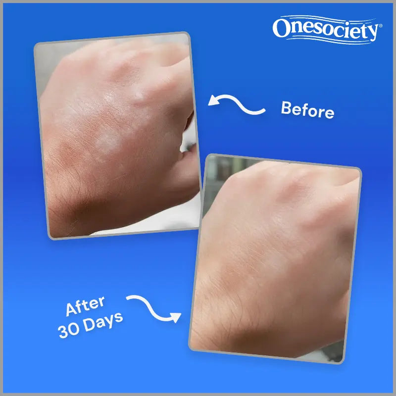 Before and after comparison of dry, cracked skin with Hemp Cream, featuring Onesociety brand.