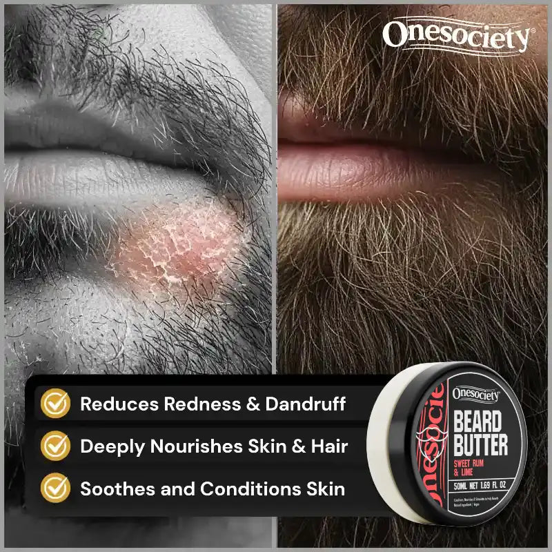 Close-up of a person's face with redness and dandruff, showing the benefits of Onesociety Beard Butter.