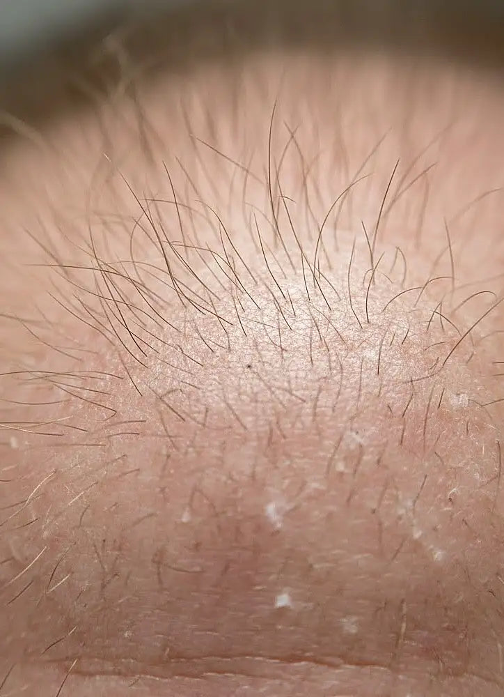 Close-up of human skin with visible hair follicles and hair loss