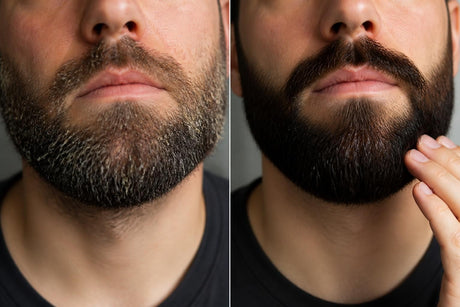 Eliminate Beard Dandruff: Science-Backed Solutions