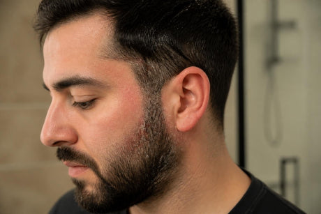 Hair and Beard Dandruff: Causes, Solutions & Prevention