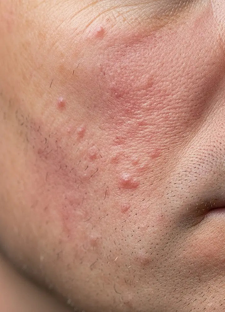 Close-up of a person's face with acne on the skin