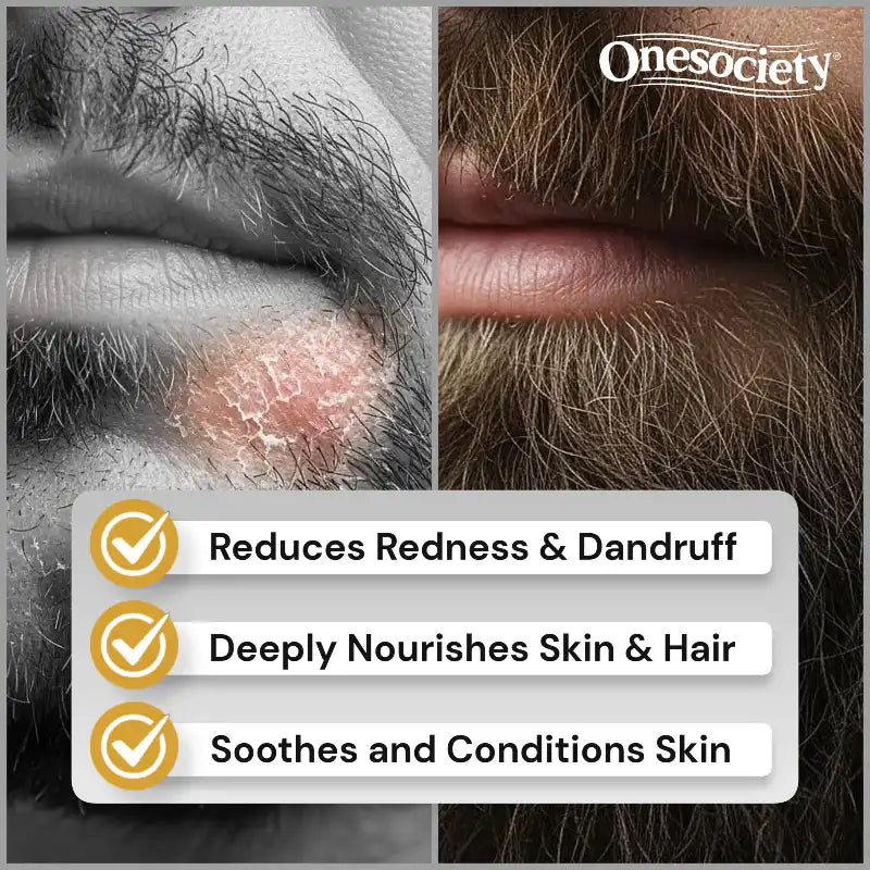 Before and after comparison of skin with redness and dandruff, showing a clear improvement, with 'Onesociety' branding.