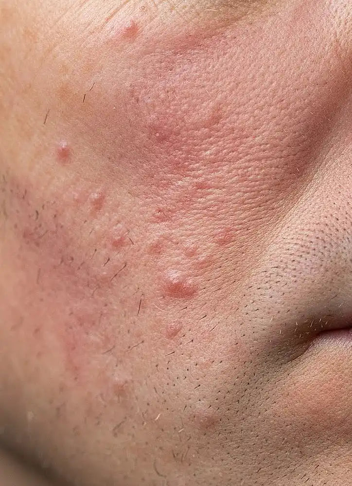 Close-up of a person's face with acne on the skin